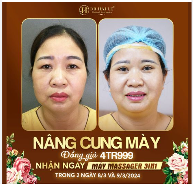 Nâng cung mày tại Dr Hải Lê - Bí kíp giúp chị em mình tìm lại thanh xuân