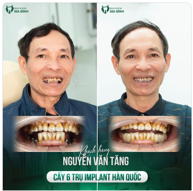 HÀM GIẢ THÁO LẮP KHÔNG CÒN LÀ GIẢI PHÁP PHÙ HỢP, CHÚ TĂNG QUYẾT ĐỊNH CẤY GHÉP IMPLANT