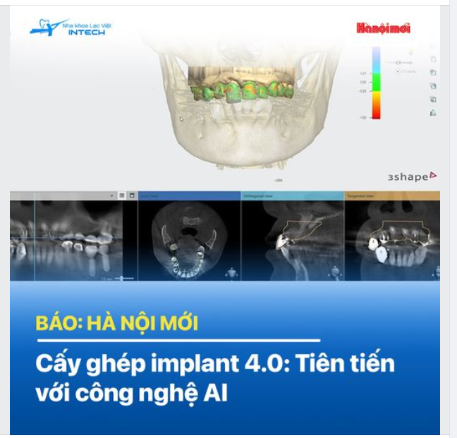 Cấy ghép implant 4.0: Tiến tiến với công nghệ AI
