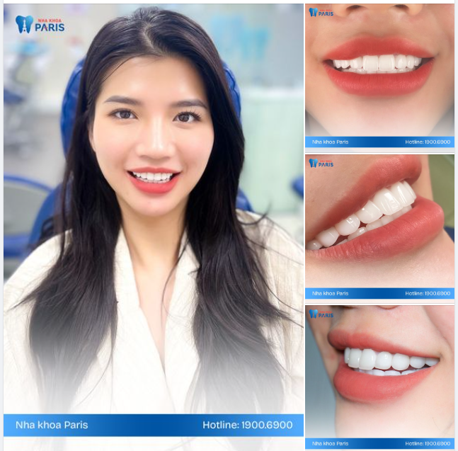 Vì nụ cười em là nắng, cho ta thêm bao mơ màng.. Cùng Nha khoa Paris và hàm răng sứ Lava Plus, Chi tự tin tỏa sáng tại trời Âu!