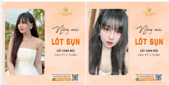 Kết quả Nâng mũi sau 1 tuần