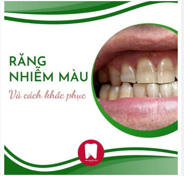 DẤU HIỆU RĂNG NHIỄM MÀU DO KHÁNG SINH CÁCH KHẮC PHỤC