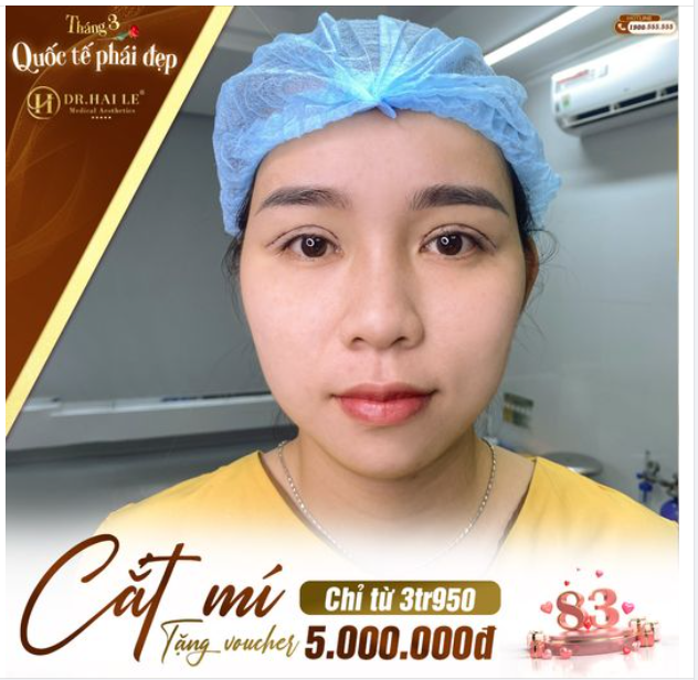 Đến ngày Dr.Hải Lê HCM cắt mí tháng 3 này, chị em rinh cho mình loạt ưu đãi sốc chưa từng có nha