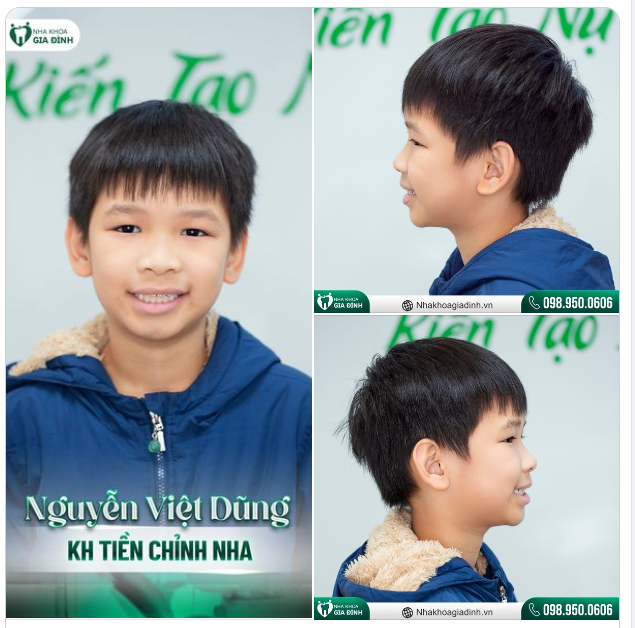 NIỀNG RĂNG SỚM CHO TRẺ - KHOẢN ĐẦU TƯ XỨNG ĐÁNG CHO TƯƠNG LAI