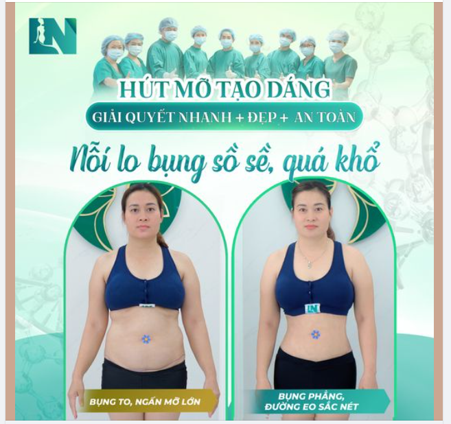XÓA SỔ MỠ BỤNG THẦN TỐC VỚI HÚT MỠ TẠO DÁNG KHÔNG CĂNG CẮT DA