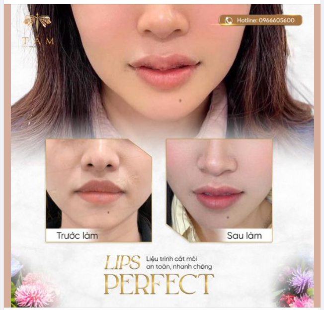 Môi dày, khuyết điểm ​​​​​​​ Thời gian ngắn Môi xinh thu hút