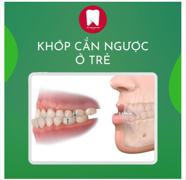 KHỚP CẮN NGƯỢC Ở TRẺ VÀ SỰ TINH Ý CỦA BẬC MẸ CHA