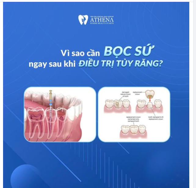 BẠN CẦN BỌC SỨ NGAY SAU KHI ĐIỀU TRỊ TỦY RĂNG NẾU KHÔNG SẼ RẤT NGUY HIỂM, TẠI SAO LẠI VẬY?