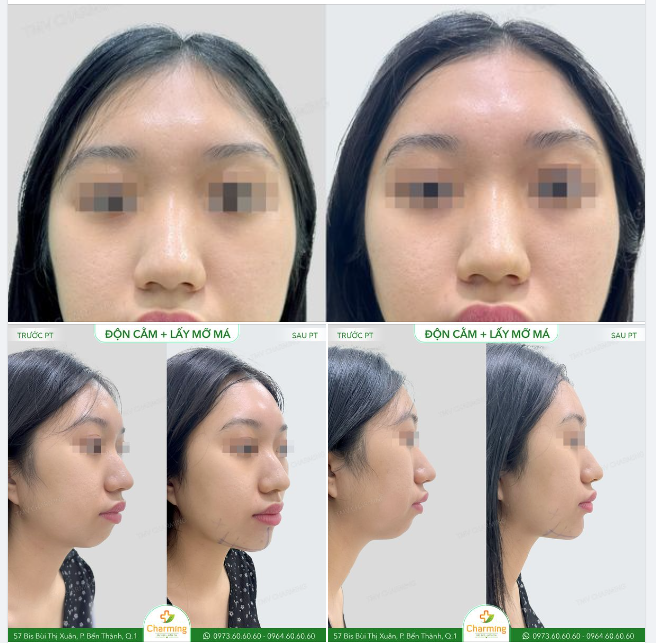 Nàng khách đã tìm đến Chamring với mong muốn khắc phục gương mặt thiếu độ dài, độ nhô của cằm cũng như hai chiếc má quá phúng phính khiến gương mặt trông to và thô. Và... hô biến