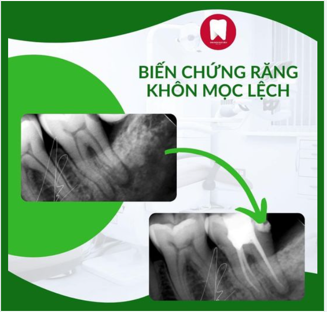 RĂNG KHÔN MỌC LỆCH KHÔNG NHỒ SỚM SẼ GÂY RA HẬU QUẢ KHÔN LƯỜNG