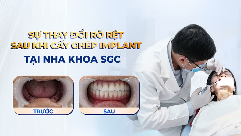 Nha khoa cấy ghép Implant chất lượng giúp đảm bảo an toàn trong lúc thực hiện