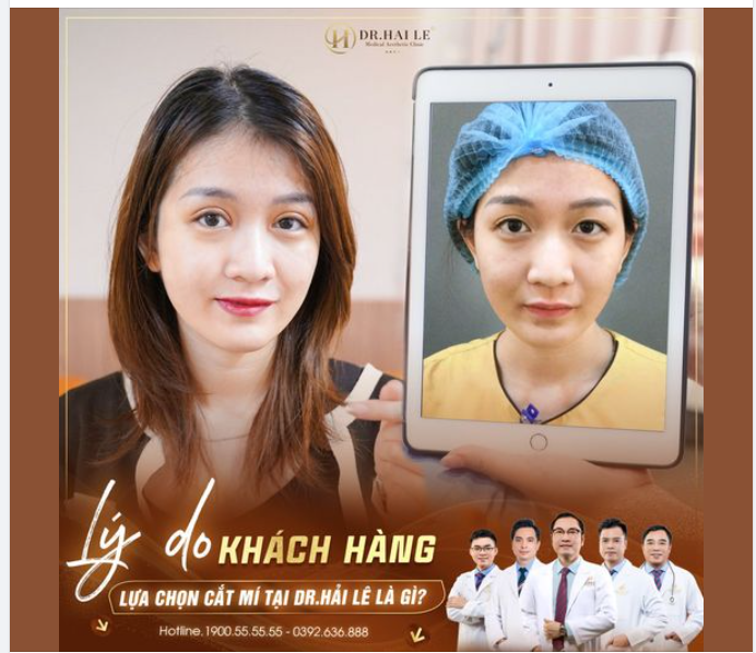 Lý do chọn cắt mí tại DR Hải Lê