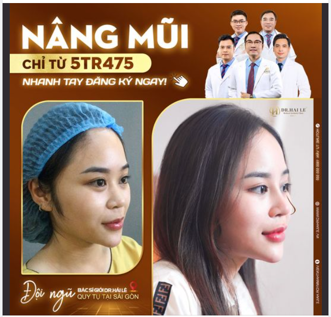 Nâng mũi nửa giá? Để Dr Hải Lê sài Gòn lo