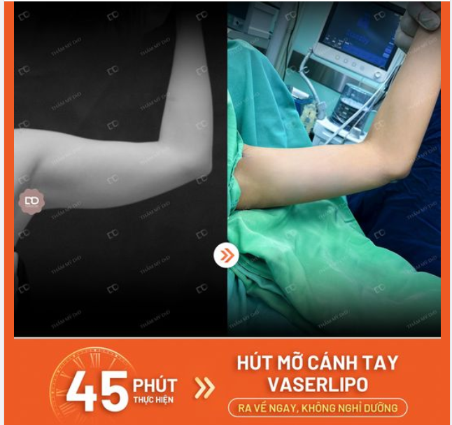 MỠ TAY KHÓ GIẢM CẢM THẤY TỰ TI Chọn Hút mỡ cánh tay VASERLIPO
