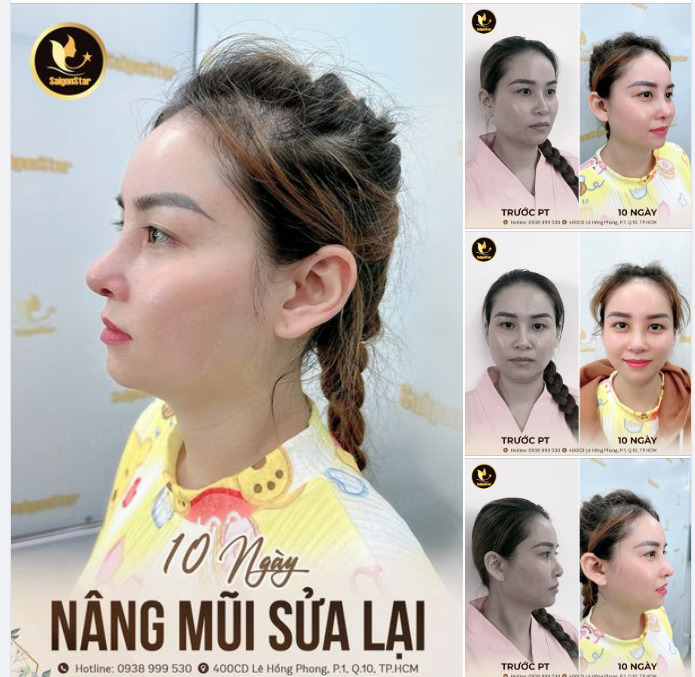 KIM CƯƠNG CÙNG CHIẾC MŨI ĐẸP CỦA CÔ ẤY 10 NGÀY NÂNG MŨI SỬA LẠI