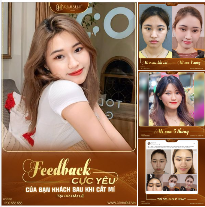 Từng sở hữu một cặp mí mang nhiều khuyết điểm như mí lót, nếp mí nhỏ, không đều nhau, không những thế đôi mắt còn có phần xếch nhẹ bạn gái luôn tự ti về đôi mắt của mình.