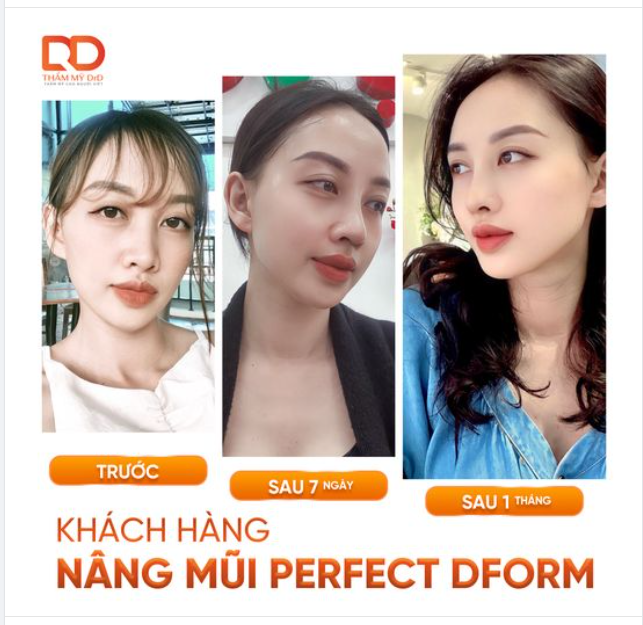 Sống mũi thấp, mũi ngắn, cánh mũi to - Giải pháp nào chỉnh sửa tối ưu nhất