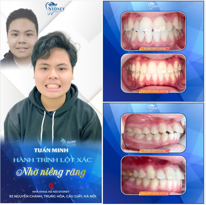 TUẤN MINH VÀ HÀNH TRÌNH LỘT XÁC NHỜ NIỀNG RĂNG