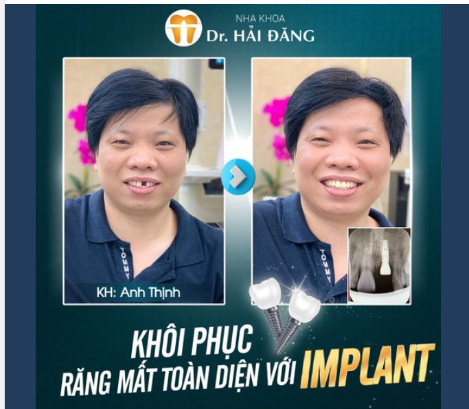 KHÔI PHỤC RĂNG MẤT TOÀN DIỆN VỚI IMPLANT