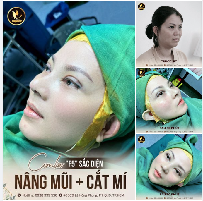 COMBO “F5” SẮC DIỆN: NÂNG MŨI + CẮT MÍ