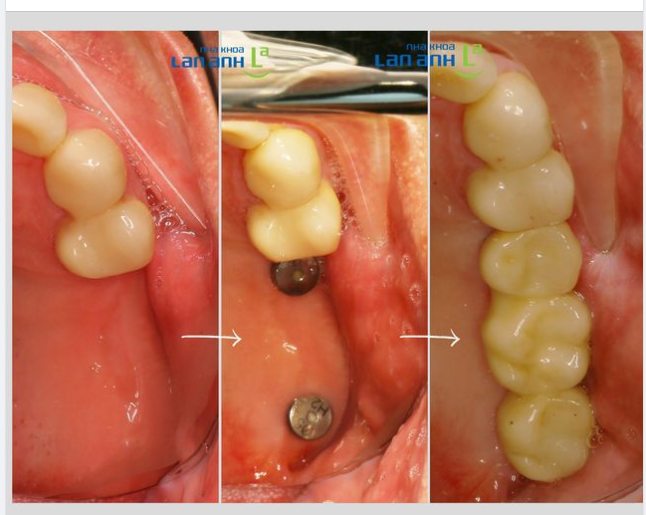 Để tiết kiệm chi phí Implant, đôi khi bạn có thể đặt 2 Implant rồi làm cầu răng lên trên.