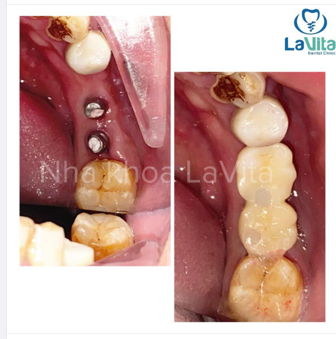 CẤY GHÉP IMPLANT - GIẢI PHÁP TRỒNG RĂNG GIẢ CHẮC KHỎE HƠN RĂNG THẬT