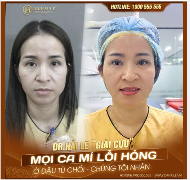 Nếu đã trót đặt nhầm niềm tin tại các cơ sở thẩm mỹ kém uy tín, thì đây là cơ hội để bạn tìm lại cho mình một cặp mí hoàn hảo