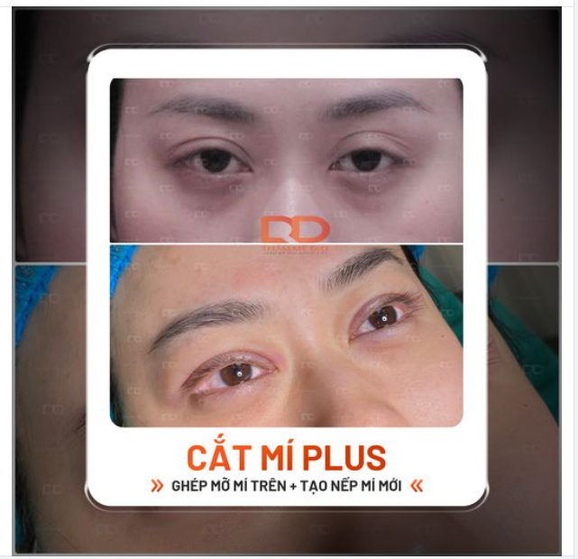Chiêm ngưỡng kết quả sửa mí + ghép mỡ ngày hôm nay.