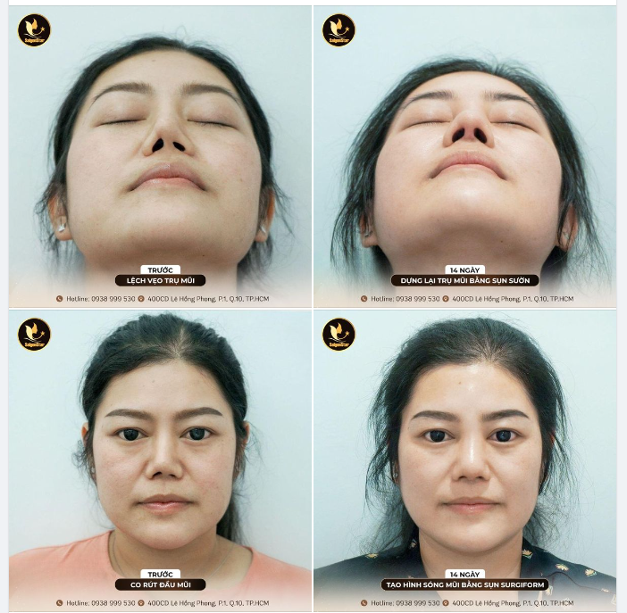 14 NGÀY PHỤC HỒI MŨI HỎNG