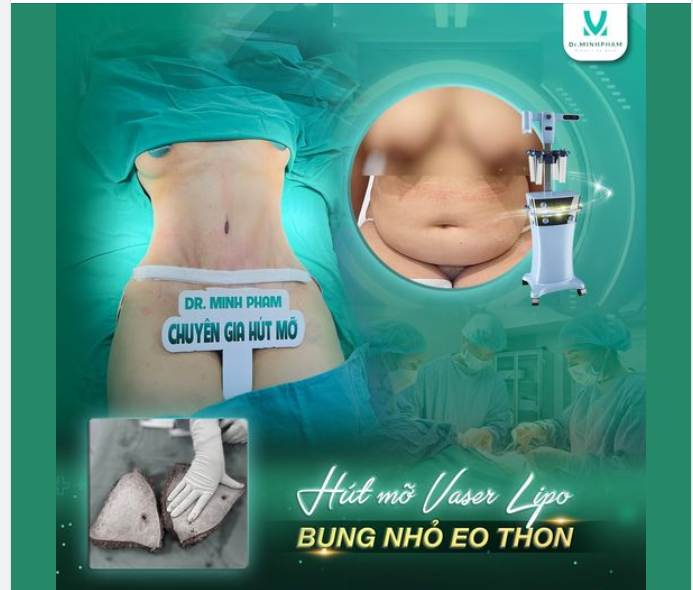 "Lột xác" ngay sau 1 lần hút mỡ tạo hình bụng tại Dr Minh Phạm