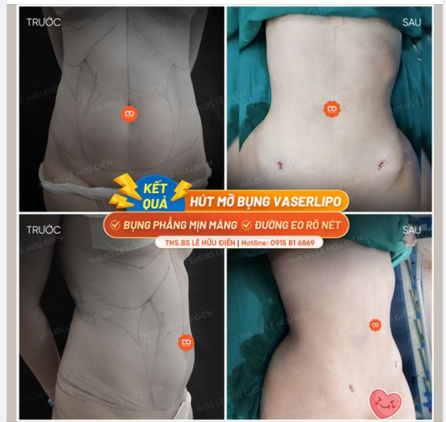 TẠI SAO HÚT MỠ VASERLIPO KHÔNG ĐỂ LẠI SẸO?