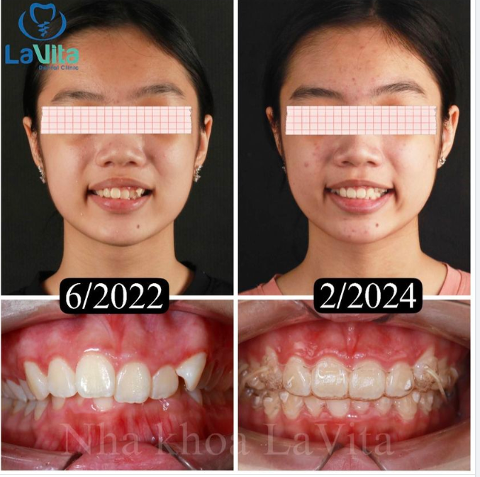 NIỀNG RĂNG VÔ HÌNH INVISALIGN - GIẢI PHÁP CHỈNH NHA HOÀN HẢO