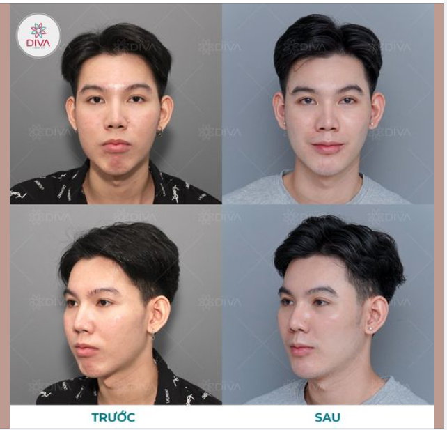 MẶT CHẢY XỆ, MẶT TRÒN DO TÚI MỠ MÁ, CẰM LẸM THIẾU ĐỘ NHÔ VÀ KẾT QUẢ SAU THẨM MỸ?