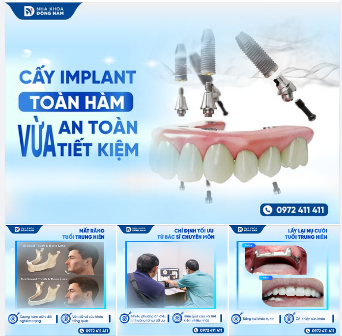 VƯỢT QUA NỖI LO CHI PHÍ: Giải Pháp Trồng Răng Implant Toàn Hàm An Toàn Tiết Kiệm