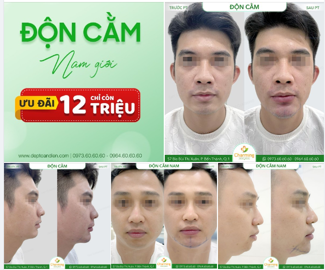 ĐỘN CẰM Ở NAM GIỚI - CÁCH GIÚP CÁNH MÀY RÂU ĐẸP NGỜI NGỜI