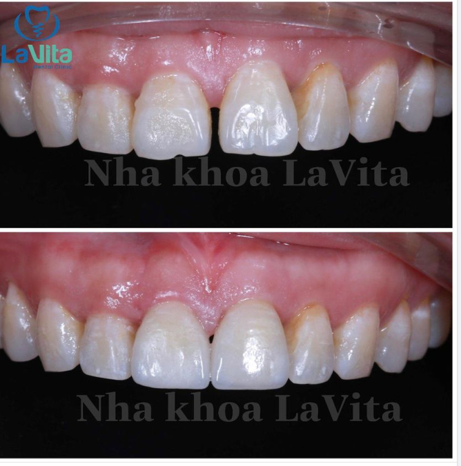 BỌC RĂNG SỨ VÀ DÁN SỨ VENEER KHÁC NHAU NHƯ THẾ NÀO?
