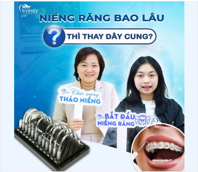 NIỀNG RĂNG BAO LÂU THÌ THAY DÂY CUNG?