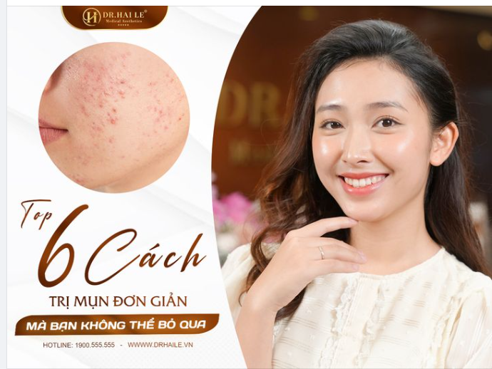 Tóp 6 cách trị mụn đơn giản mà bạn không thể bỏ qua