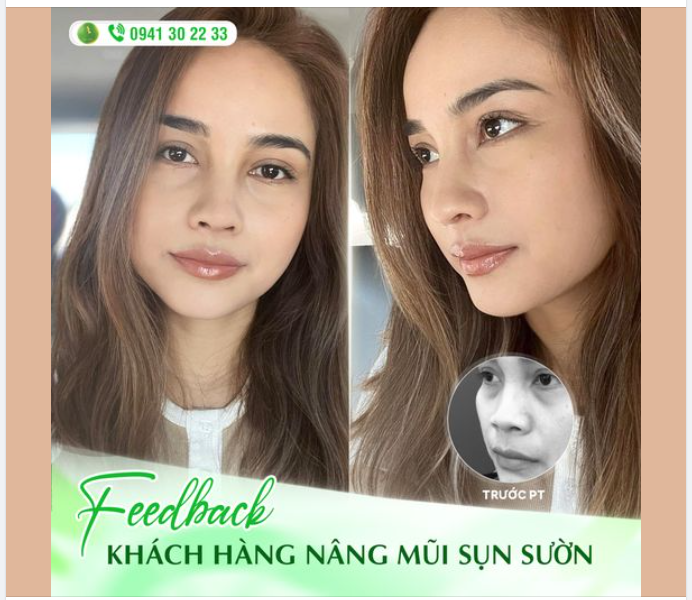 TỰ TIN VỚI DÁNG MŨI SỤN SƯỜN HOÀN HẢO