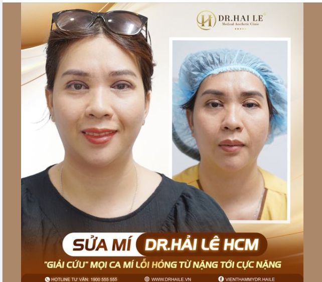 Mí lỗi hỏng dù là tình trạng nào cũng khiến chị em trở nên tự ti vô cùng.