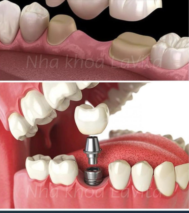 ƯU ĐIỂM CỦA CẤY GHÉP IMPLANT SO VỚI PHƯƠNG PHÁP LÀM CẦU RĂNG