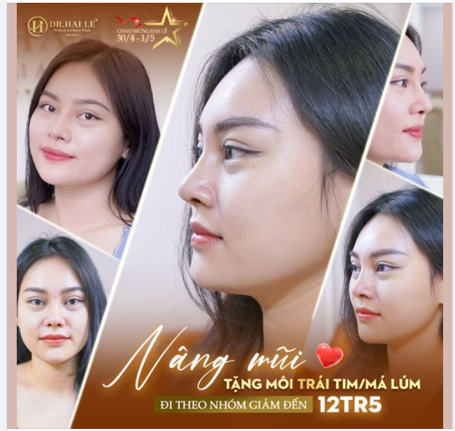 Mừng đại lễ sale tưng bừng. Nâng mũi chỉ từ 10tr950