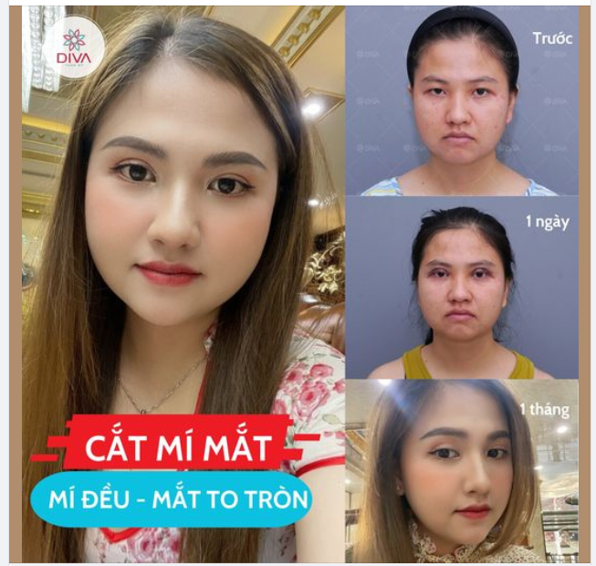 Cô gái này đã tạm biệt đôi mắt một mí, mắt nhiều da dư, mỡ thừa..chỉ với một dịch vụ thẩm mỹ ?