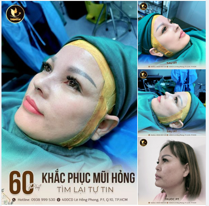 THÀNH CÔNG GIÚP KHÁCH HÀNG ĐÀI LOAN TÌM LẠI TỰ TIN SAU 2 LẦN NÂNG MŨI HỎNG