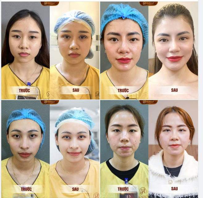 Ảnh trước sau ️ Kết quả cắt mí Mani Mini Deep - TƯƠI TRẺ, RẠNG NGỜI 