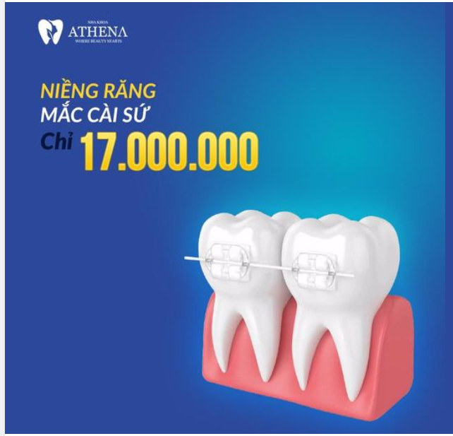 NIỀNG RĂNG MẮC CÀI SỨ CHỈ TỪ 17.000.000