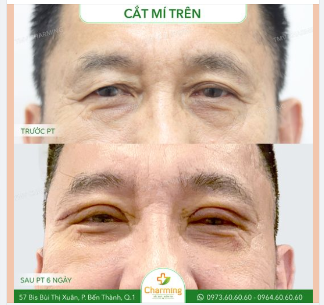 Không chỉ có phụ nữ mới được làm đẹp hay cụ thể là cắt mí đâu, cánh mày râu cũng có thể thực hiện cắt mí trên để loại bỏ phần da chùng khó ưa đang cản trở tầm nhìn của mình đó.
