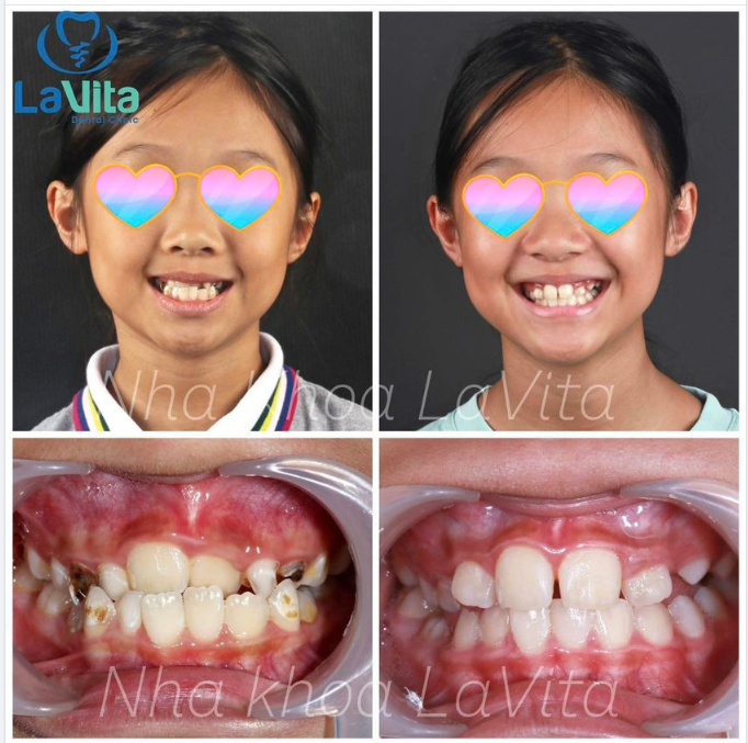 THẾ NÀO LÀ KHỚP CẮN NGƯỢC?