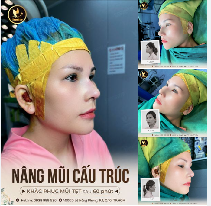 NÂNG MŨI CẤU TRÚC – MŨI THẤP TẸT HÓA CAO SANG SAU 60 PHÚT