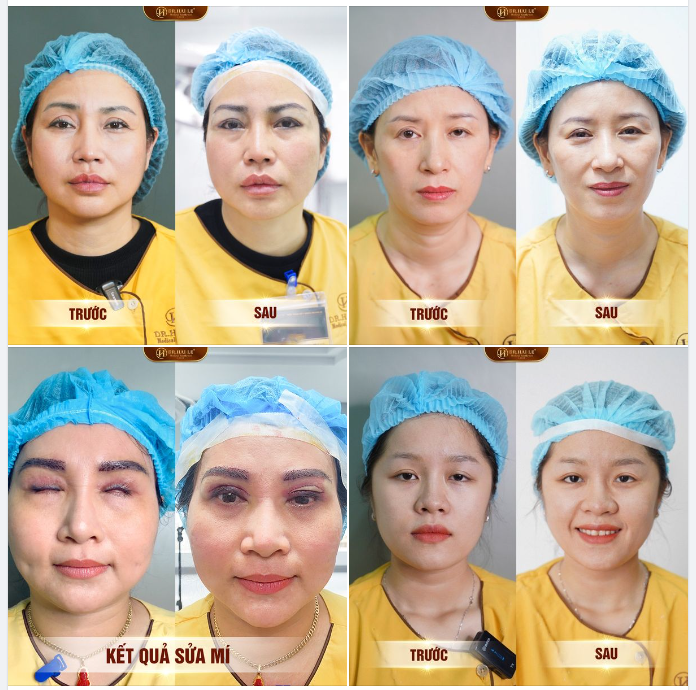 HỆ LỤY TỪ BIẾN CHỨNG MÍ HỎNG - KINH NGHIỆM PTTM MẮT AN TOÀN - ĐÂU LÀ THỜI ĐIỂM VÀNG SỬA MÍ LỖI HỎNG HIỆU QUẢ